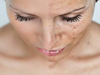 Peeling
